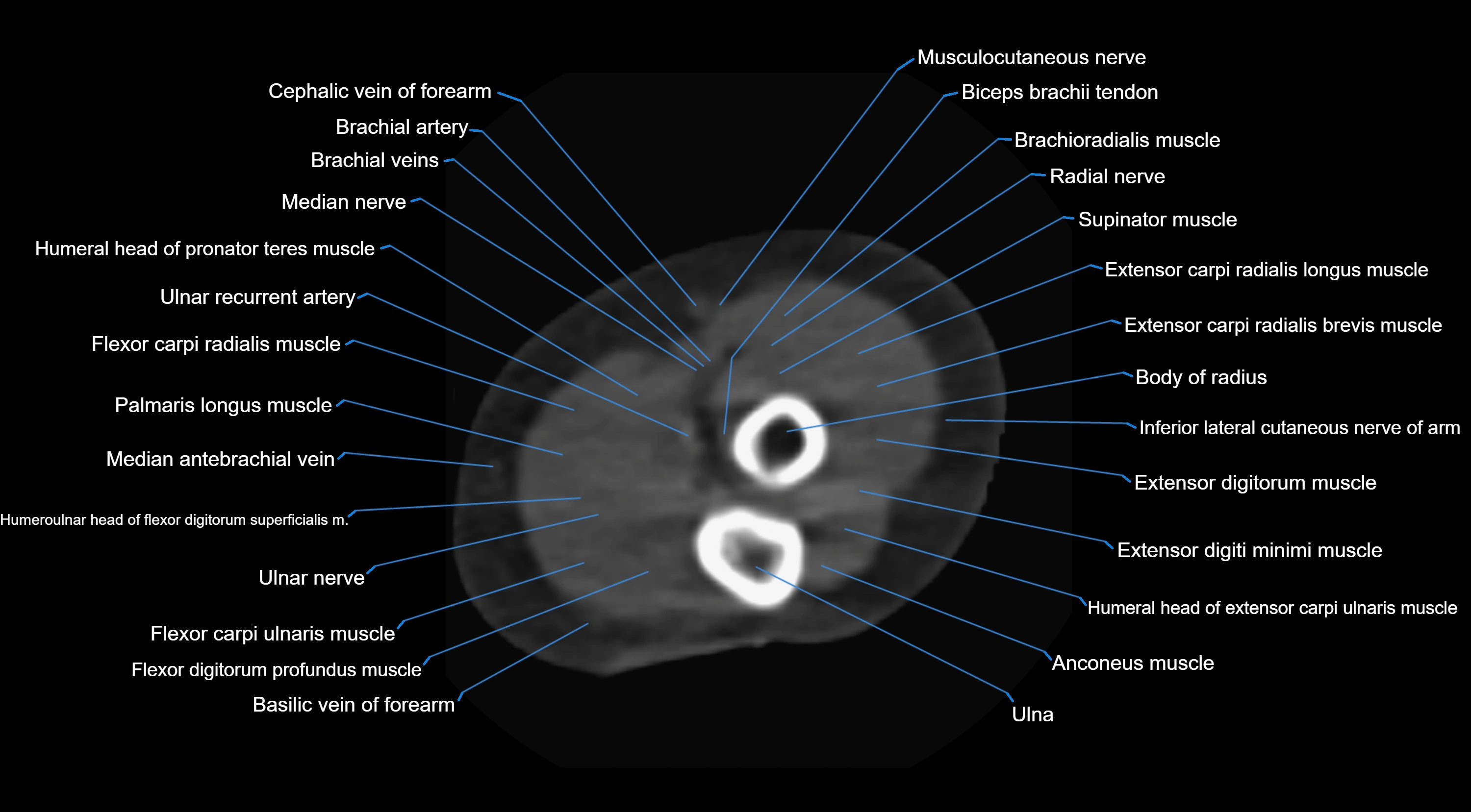 CT elbow axial  cross sectional anatomy labelled  radiology image -00042.webp